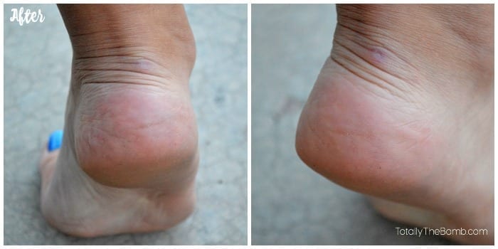 cracked heel solution