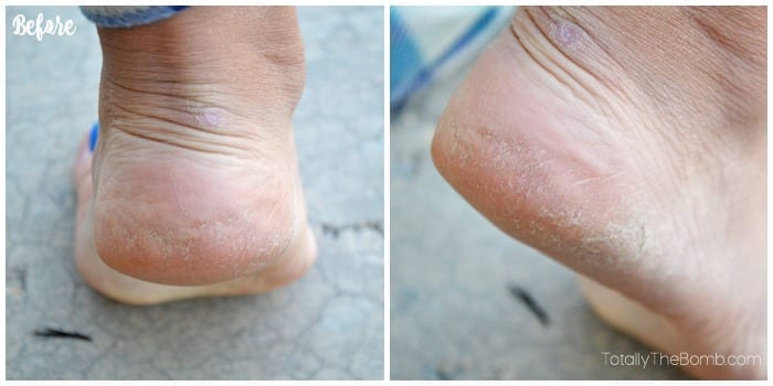 cracked heel solution