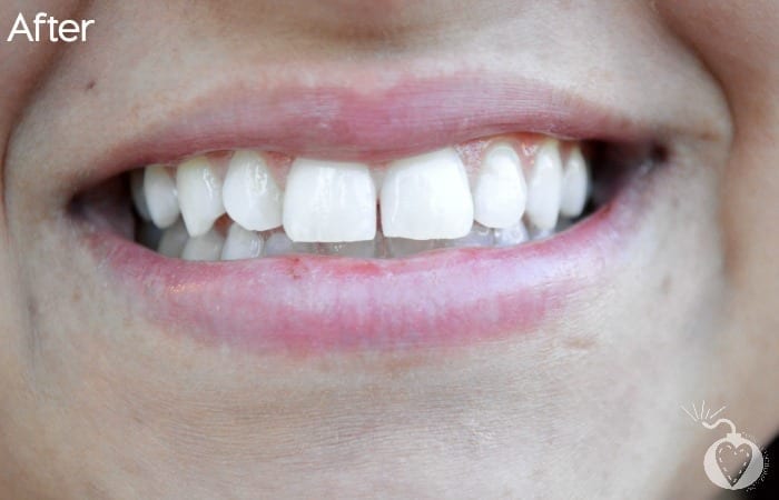 smile after
