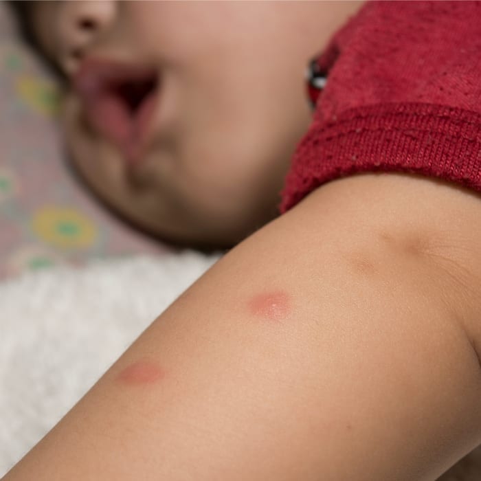 mosquito bite baby