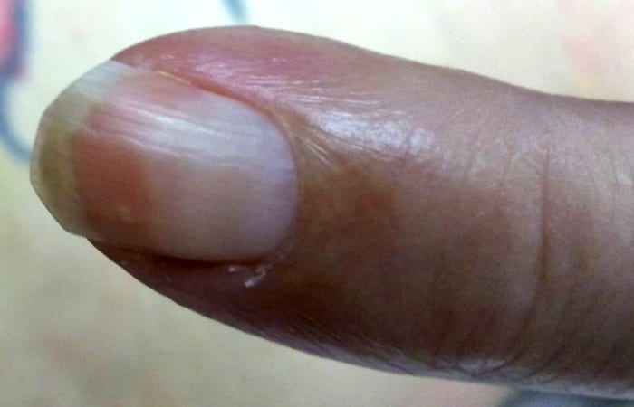 aging nails are often pinker at the top of the nail and paler towards the cuticle