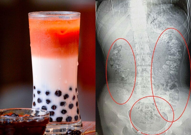 This 14-Year-Old Girl Had More Than 100 Bubble Tea Balls Stuck Inside Her Body