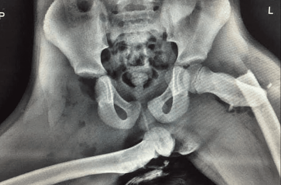 This X-Ray Shows What Can Happen If You Get Into A Car Accident With Your Feet Up On The Dashboard