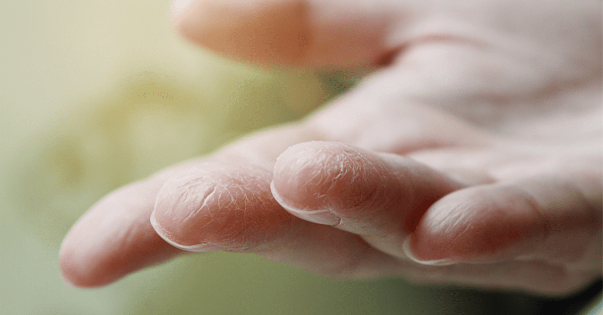 Here’s How to Fix Dry Raw Hands from Hand Washing