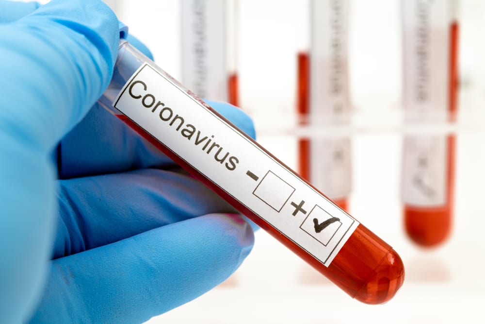 The CDC Has Agreed to Pay for Coronavirus Testing