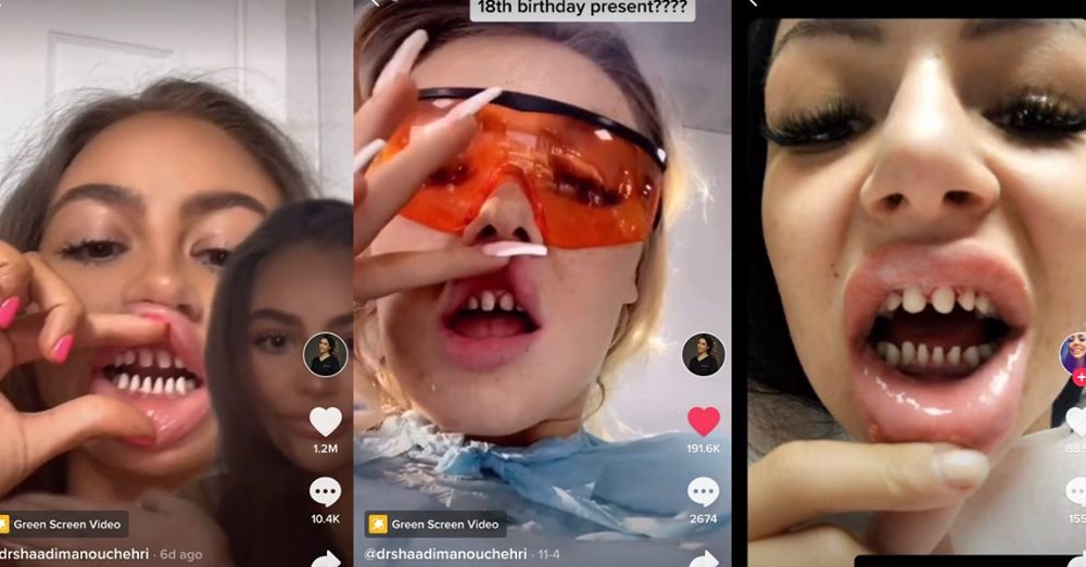 Kids Are Filing Down Their Teeth and Here’s What Dentists Want Parents To Know