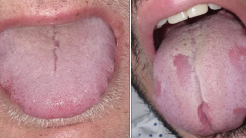 ‘COVID Tongue’ May Be The Newest Coronavirus Symptom You Need To Know About