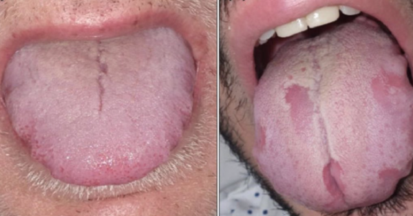 ‘COVID Tongue’ May Be The Newest Coronavirus Symptom You Need To Know About