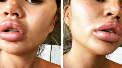 Chrissy Teigen’s Lips Swelled Up So Bad After She Bit Into A ‘Suspicious Orange’