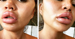 Chrissy Teigen’s Lips Swelled Up So Bad After She Bit Into A ‘Suspicious Orange’