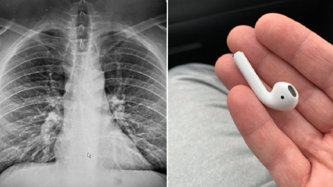 This Guy Swallowed One of His AirPods and He Is Lucky To Be Alive