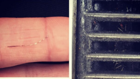 This Woman Had A Wire Bristle Stuck In Her Throat And It Is Terrifying