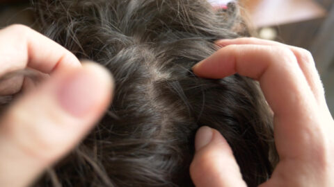 Doctors Are Begging People To Not Try The ‘Scalp Popping’ Trend That Is Going Around Right Now