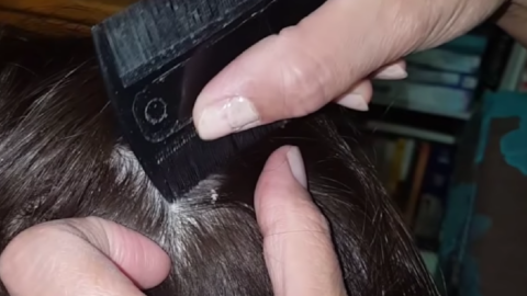 Dandruff Scalp Scraping Videos Are The New Pimple Popping Videos And They Are Oddly Satisfying
