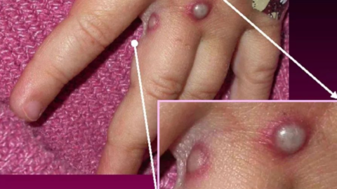 What Is Monkeypox and Why is Everyone Talking About It?