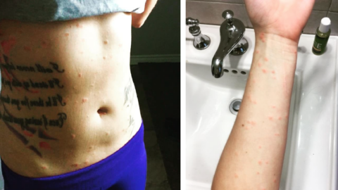 ‘Swimmer’s Itch’ Is A Thing and Now I’m Terrified of The Water
