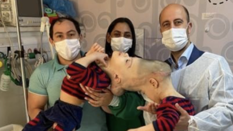 Conjoined Twins With Fused Brains Were Separated In A Historical Surgery And My Heart Is Full