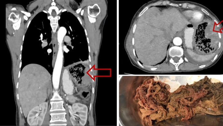 Doctors Just Removed A Piece Of Gauze From A Patient That Was Accidentally Left In Her Abdomen For 20 Years