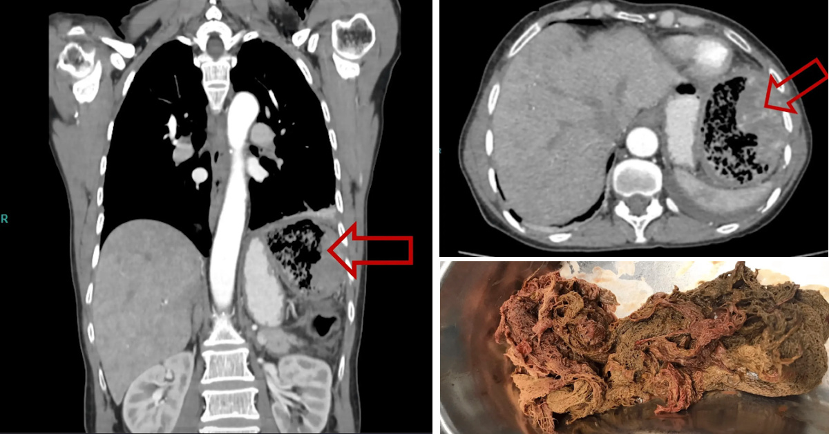 Doctors Just Removed A Piece Of Gauze From A Patient That Was Accidentally Left In Her Abdomen For 20 Years