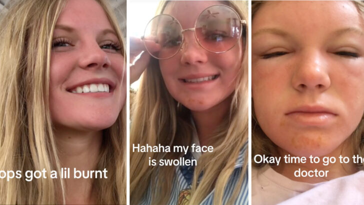 This Woman Got ‘Sun Poisoning’ And Now She Is Warning Others