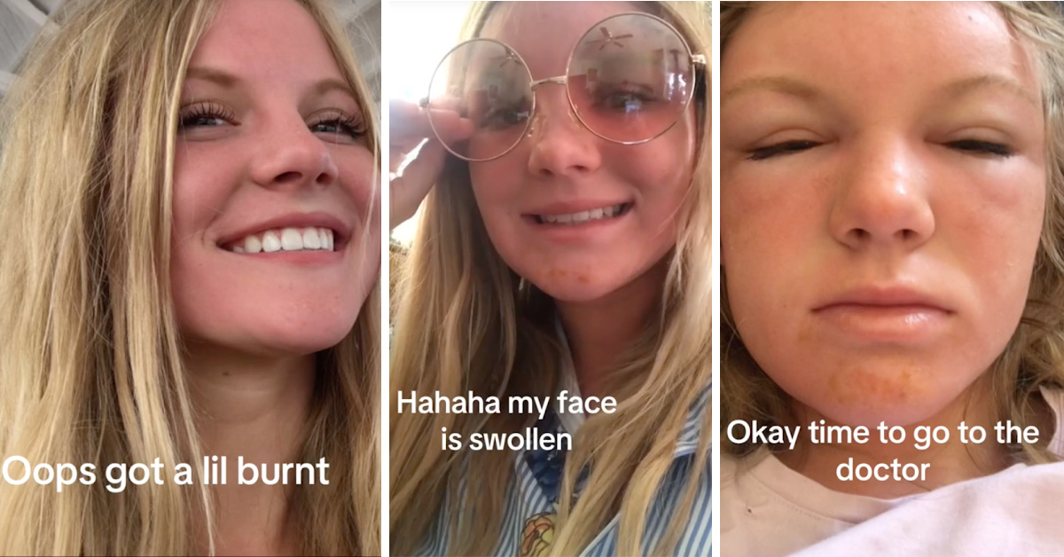 This Woman Got ‘Sun Poisoning’ And Now She Is Warning Others