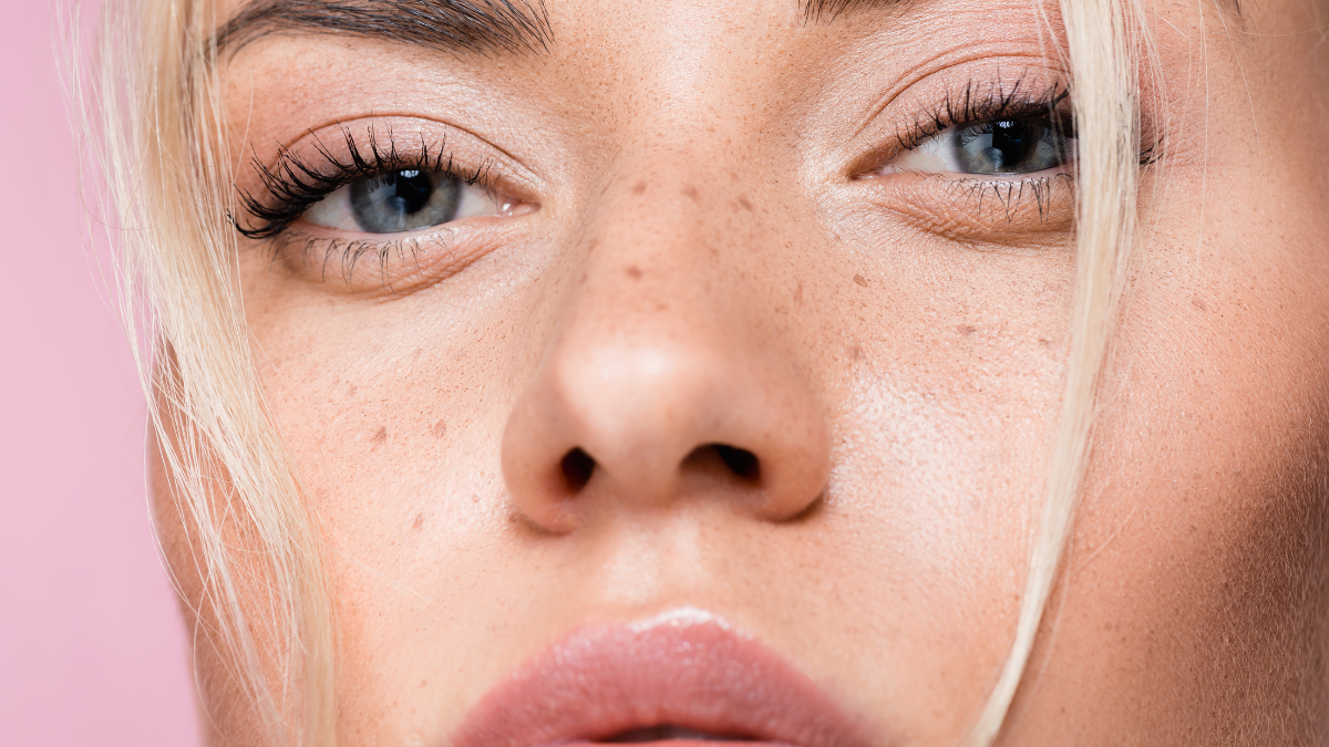 freckles