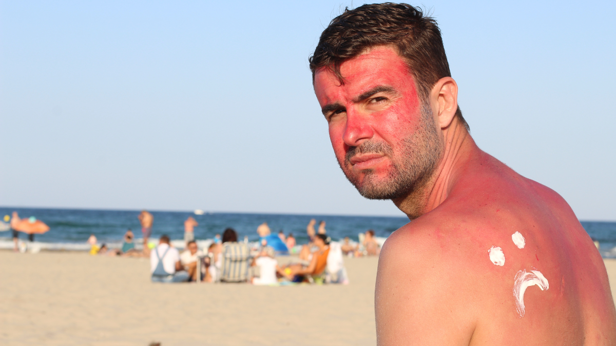 man sunburned